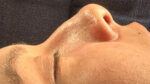 Rhinoplasty