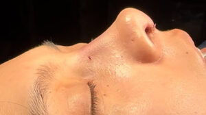 Rhinoplasty