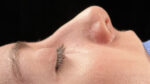 Rhinoplasty