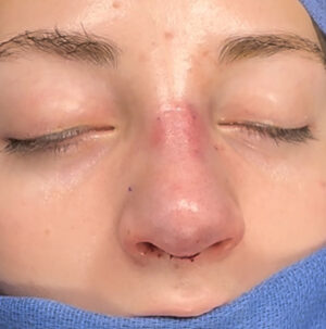 Rhinoplasty