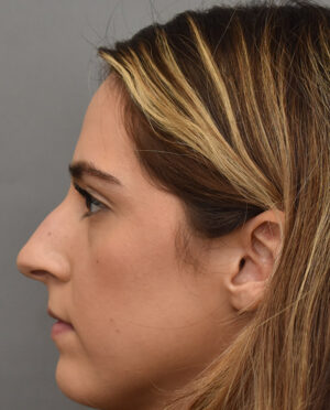 Rhinoplasty