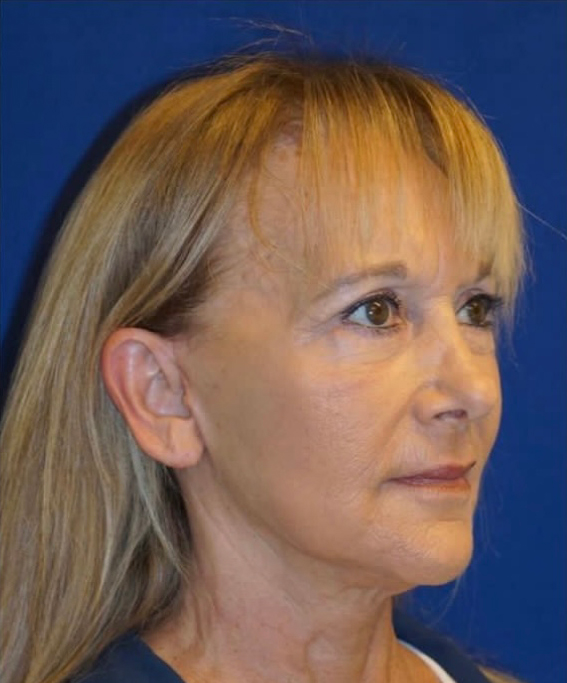 Necklift After Photo Necklift After Photo