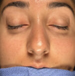 Rhinoplasty