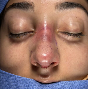 Rhinoplasty