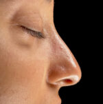 Rhinoplasty