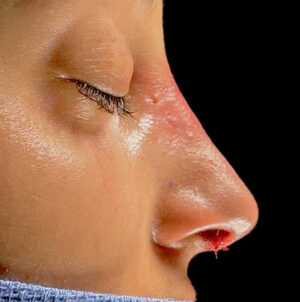 Rhinoplasty