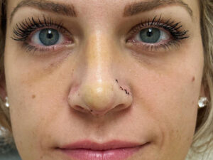 Revision Rhinoplasty