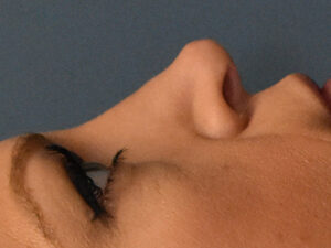 Revision Rhinoplasty