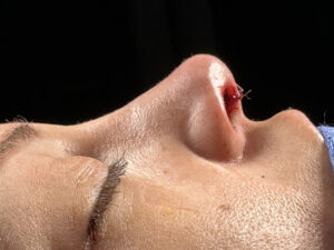 Revision Rhinoplasty