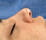 Rhinoplasty