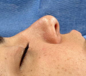 Rhinoplasty