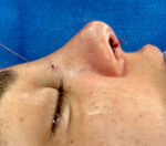 Rhinoplasty