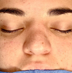 Rhinoplasty