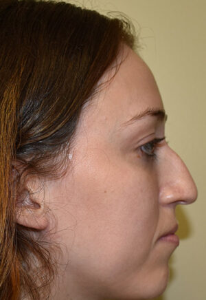 Rhinoplasty