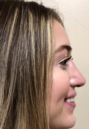 Rhinoplasty