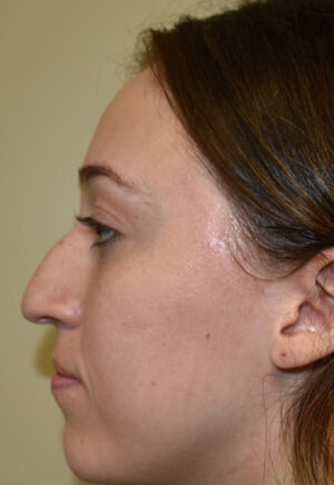 Rhinoplasty