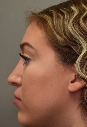 Rhinoplasty