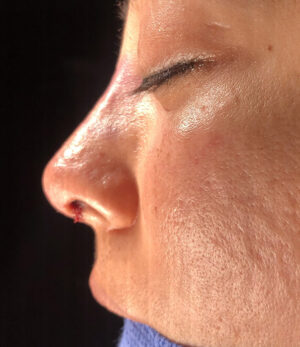 Rhinoplasty