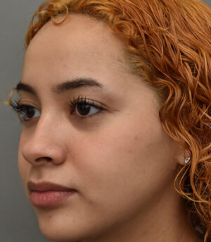 Rhinoplasty