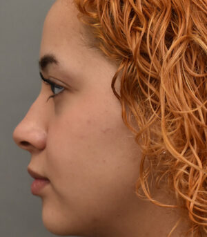 Rhinoplasty