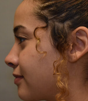 Rhinoplasty