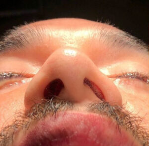 Rhinoplasty