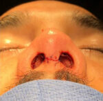 Rhinoplasty